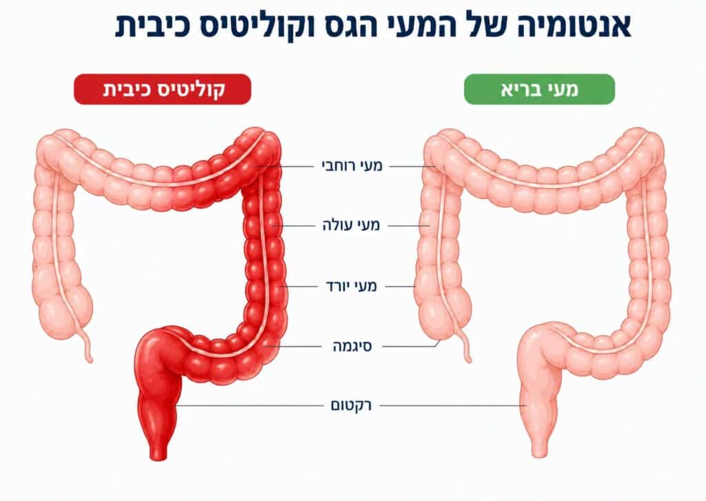 המחשה - מעי רגיל לעומת מעי של חולה קוליטיס